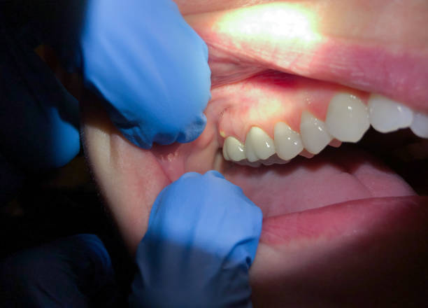 Best Emergency Dental Care for Abscessed Tooth in Hunters Creek Village, TX