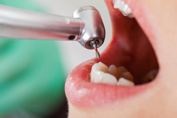 Best Emergency Dentist for Lost Fillings or Crowns in Hunters Creek Village, TX